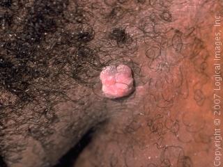 Genital Warts Ingrown Hair Gullu