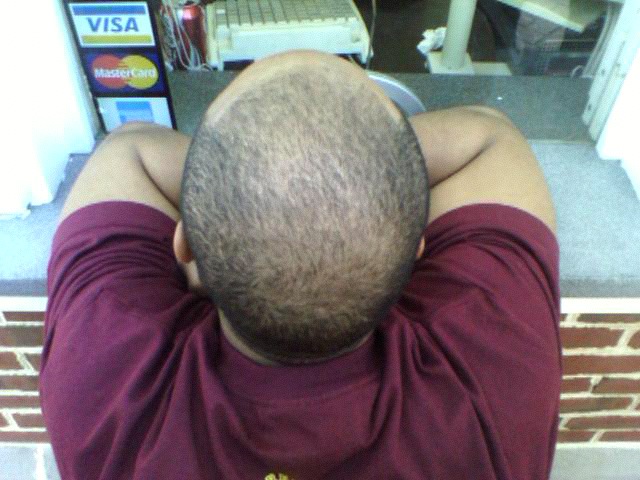 What Can I Do About My Hair Falling Out?