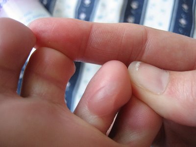 Las grietas en la piel de los dedos cerca de las uñas de la causa y el tratamiento